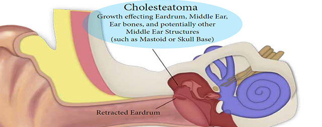 A Simple Ear Infection Can Make you Homeless